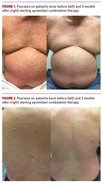 Apremilast And Secukinumab Combined Therapy In A Patient With 