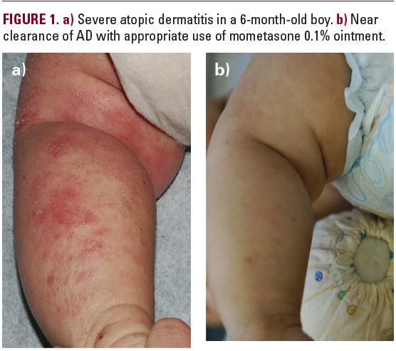 Management of Severe Atopic Dermatitis in Children - JDDonline ...