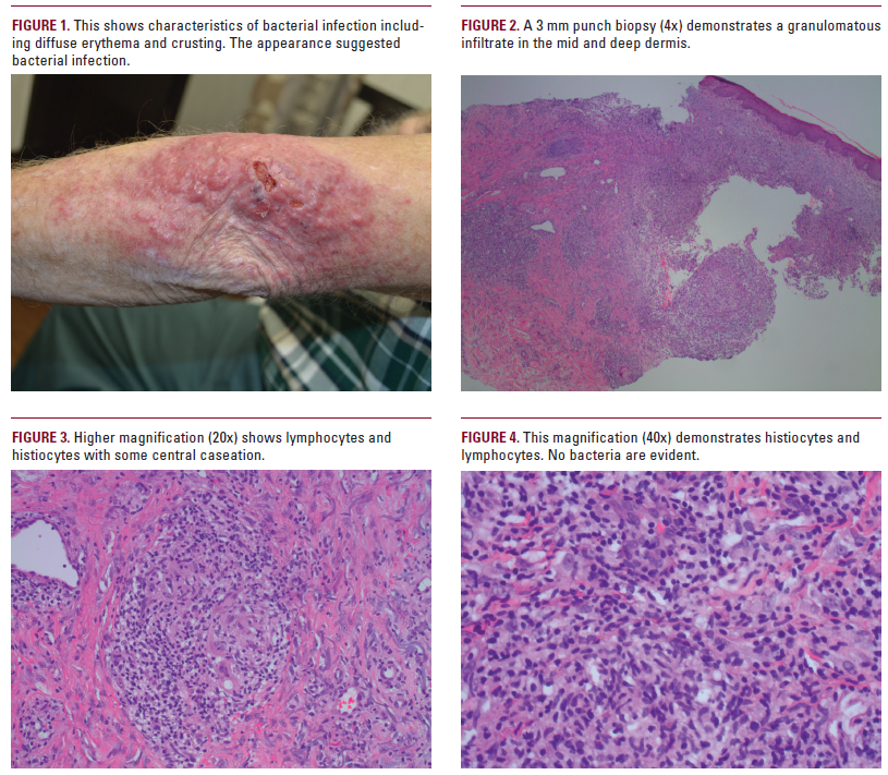 Cutaneous Non-Tuberculous Mycobacterial Infections in the Outpatient ...
